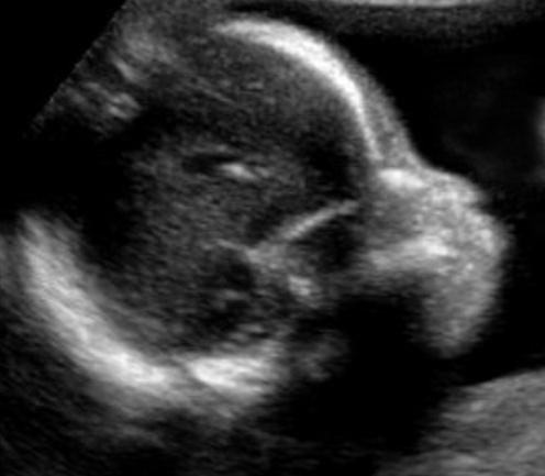 Head in the womb