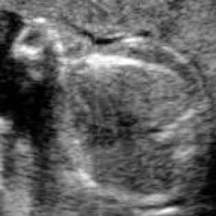 A fetal heart